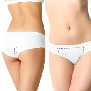 Depilación Láser Bikini Brasilero